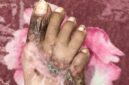Kondisi kaki Massyura luka berat (cacat permanen ) , 4 jari kaki nya tak berfungsi dan hanya jempol kaki yang berfungsi