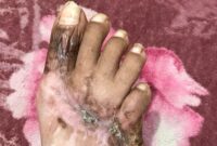 Kondisi kaki Massyura luka berat (cacat permanen ) , 4 jari kaki nya tak berfungsi dan hanya jempol kaki yang berfungsi