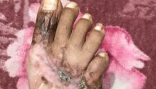 Kondisi kaki Massyura luka berat (cacat permanen ) , 4 jari kaki nya tak berfungsi dan hanya jempol kaki yang berfungsi